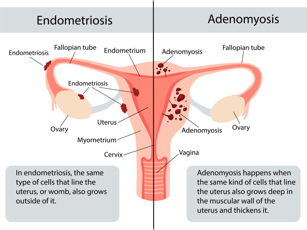 Visual showing where Adenomyosis tissue can develop