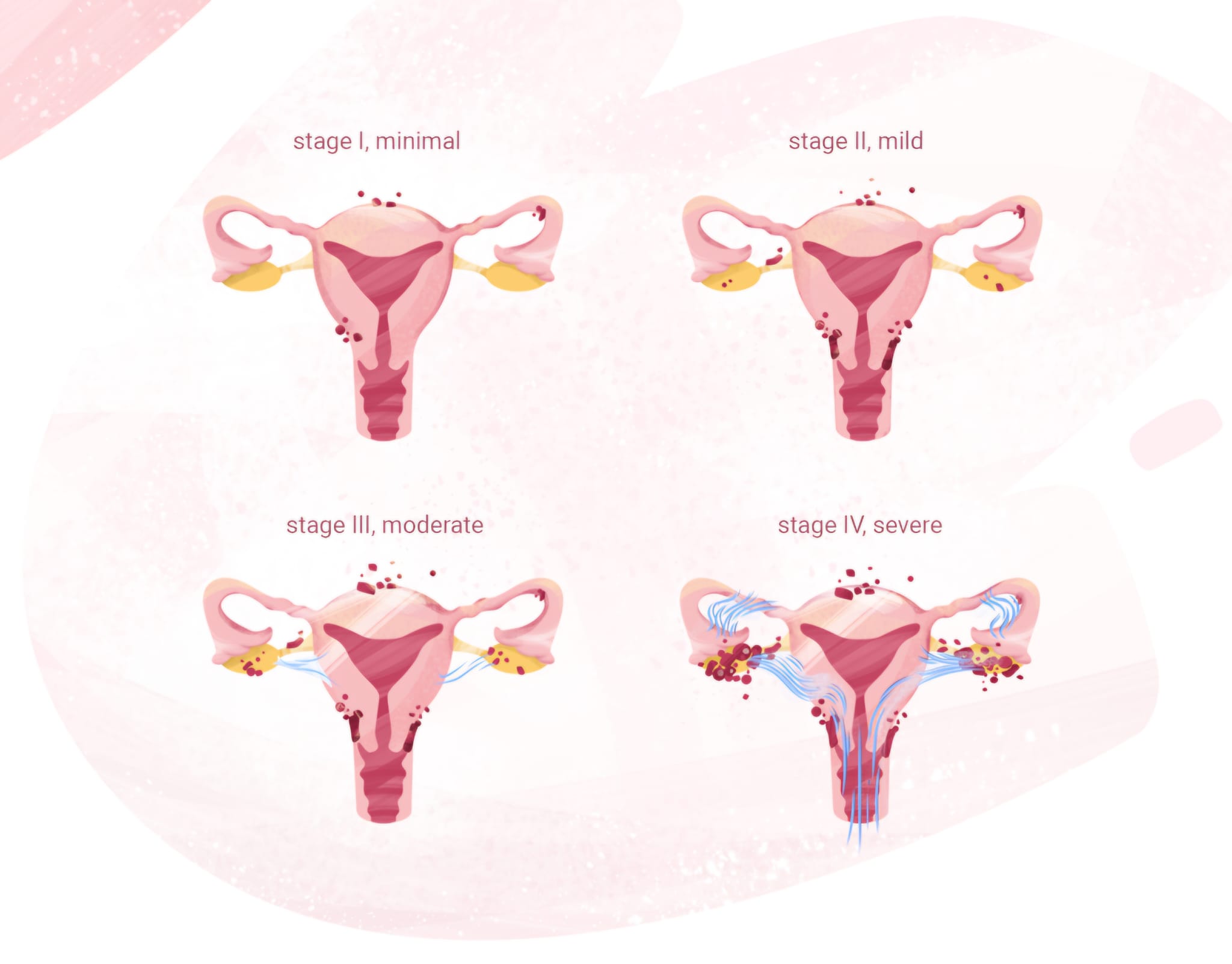 endometriosis stages