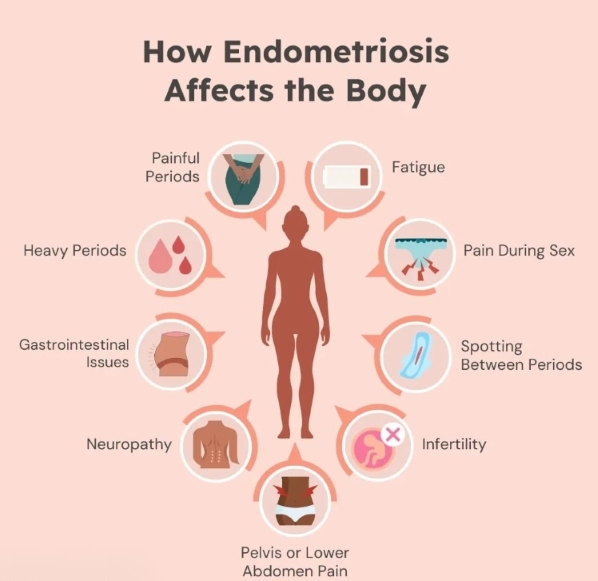 Illustration of common endometriosis experiences