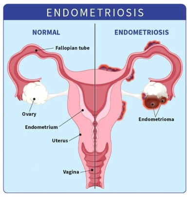 Visual showing where endometriosis tissue can develop